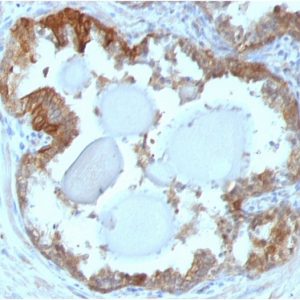 Formalin-fixed, paraffin-embeddedhuman prostate carcinoma stained with HSP27 Mouse Monoclonal Antibody (G3.1).