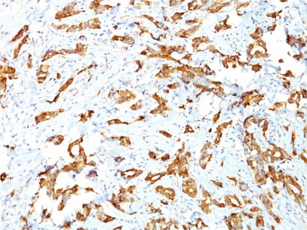 Formalin-fixed, paraffin-embeddedhuman breast carcinoma stained with HSP27 Mouse Monoclonal Antibody (G3.1).