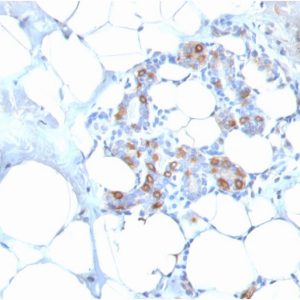Formalin-fixed, paraffin-embedded human breast carcinoma stained with HSP27 Mouse Monoclonal Antibody (SPM252).