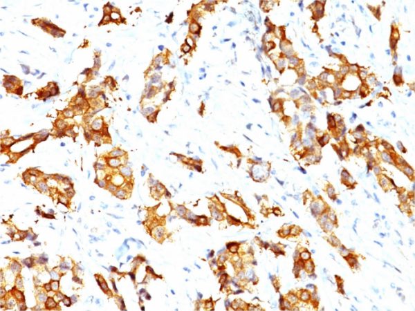 Formalin-fixed, paraffin-embedded human breast carcinoma stained with HSP27 Mouse Monoclonal Antibody (SPM252).
