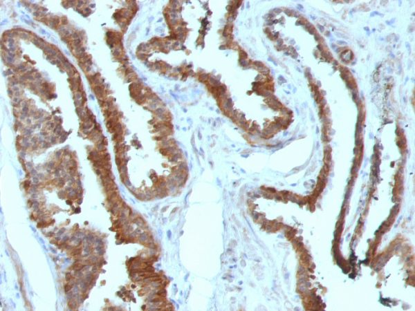 Formalin-fixed, paraffin-embedded human Prostate Carcinoma stained with HSP27 Monoclonal Antibody (HSPB1/774)