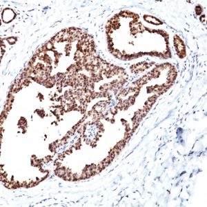Formalin-fixed, paraffin-embedded human Breast Carcinoma stained with HSP60 Monoclonal Antibody (LK1)