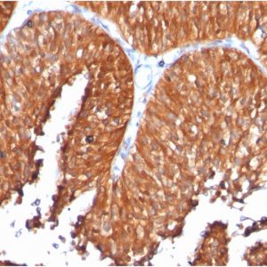 Formalin-fixed, paraffin-embedded human Bladder Carcinoma stained with HSP60 Monoclonal Antibody (SPM253)