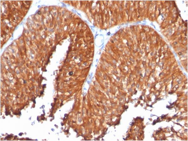 Formalin-fixed, paraffin-embedded human Bladder Carcinoma stained with HSP60 Monoclonal Antibody (SPM253)