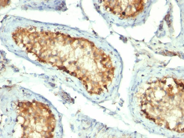 Formalin-fixed, paraffin-embedded human Testicular Carcinoma stained with HSP60 Monoclonal Antibody (GROEL/730)