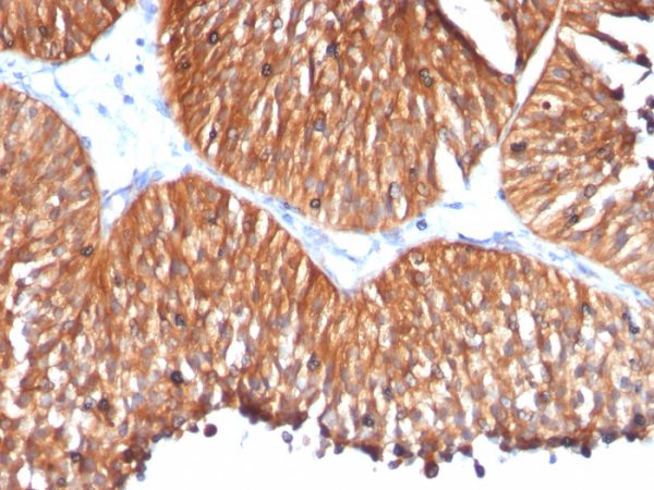 Formalin-fixed, paraffin-embedded human Bladder Carcinoma stained with HSP60 Mouse Monoclonal Antibody (HSPD1/780)