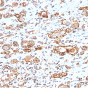 Formalin-fixed, paraffin-embedded human renal cell carcinoma stained with HSP60 Mouse Monoclonal Antibody (CPTC-HSPD1-1).