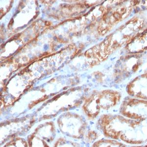 Formalin-fixed, paraffin-embedded human Renal Cell Carcinoma stained with HSP60 Mouse Monoclonal Antibody (AE-1).