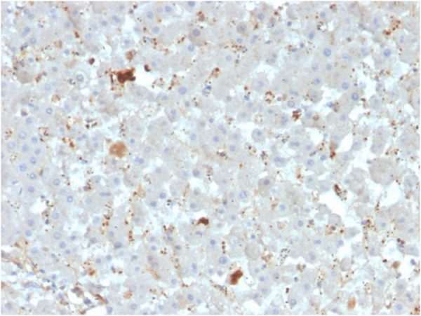 Formalin-fixed, paraffin-embedded human liver carcinoma stained with Apolipoprotein A4 Mouse Monoclonal Antibody (APOA4/3372).