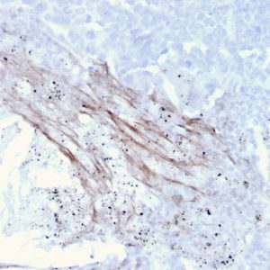 Formalin-fixed, paraffin-embedded human Lung Carcinoma stained with Tenascin C Mouse Recombinant Monoclonal Antibody (rTNC/3635).