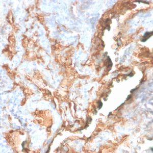 Formalin-fixed, paraffin-embedded human Lung Carcinoma stained with Tenascin C Rabbit Recombinant Monoclonal Antibody (TNC/2981R).