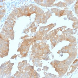 Formalin-fixed, paraffin-embedded human prostate carcinoma stained with IDH1 Mouse Monoclonal Antibody (IDH1/1152).