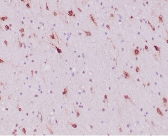 FFPE human glioblastoma with IDH1-R132H mutation stained with  IDH1-R132H Recombinant Rabbit Monoclonal Antibody (IDH1/6806R). HIER: Tris/EDTA, pH9.0, 45min. 2 °: HRP-polymer, 30min. DAB, 5min.