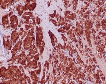 FFPE prostate carcinoma with IDH1-R132H mutation stained with IDH1-R132H Recombinant Rabbit Monoclonal Antibody (IDH1/6806R).
