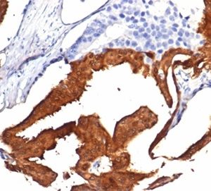 FFPE human prostate with IDH1-R132H mutation stained with  IDH1-R132H Recombinant Rabbit Monoclonal Antibody (IDH1/7277R). HIER: Tris/EDTA, pH9.0, 45min. 2 °: HRP-polymer, 30min. DAB, 5min.