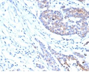 Formalin-fixed, paraffin-embedded human colon carcinoma stained with IGF-1R / CD221 Mouse Monoclonal Antibody (IGF1R/4667).