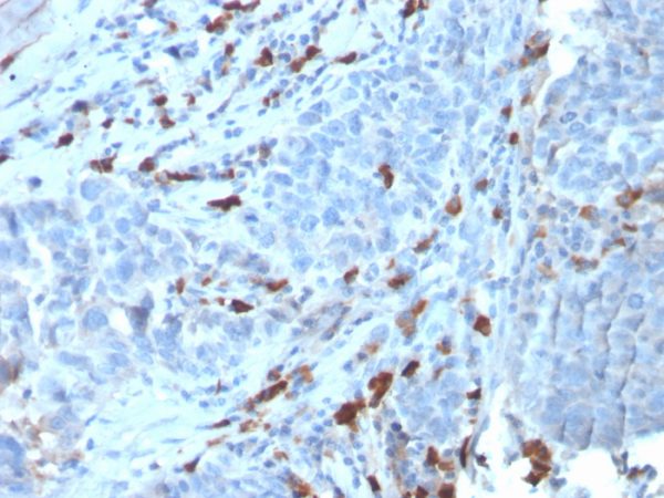 Formalin-fixed, paraffin-embedded human Tumor stained with IgM Recombinant Rabbit Monoclonal Antibody (IGHM/3135R).