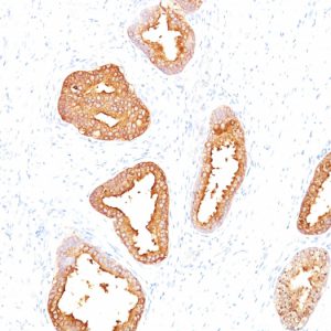 Formalin-fixed, paraffin-embedded human Prostate Carcinoma stained with PSA Mouse Monoclonal Antibody (A67-B/E3).