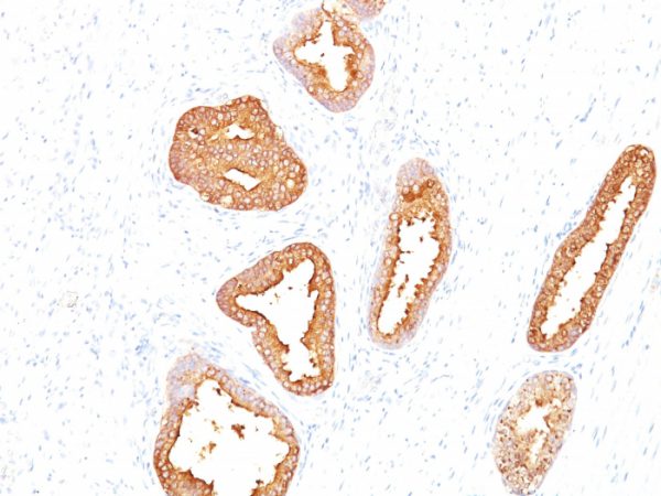 Formalin-fixed, paraffin-embedded human Prostate Carcinoma stained with PSA Mouse Monoclonal Antibody (A67-B/E3).