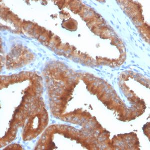 Formalin-fixed, paraffin-embedded human prostate carcinoma stained with PSA Recombinant Mouse Monoclonal Antibody (rKLK3/4753).
