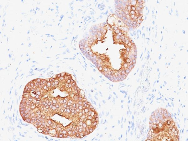 Formalin-fixed, paraffin-embedded human Prostate Carcinoma stained with Prostate Specific Antigen Mouse Monoclonal Antibody (1A7).
