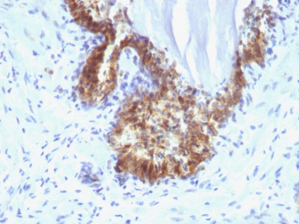 Formalin-fixed, paraffin-embedded human Prostate Carcinoma stained with PSA Mouse Monoclonal Antibody (KLK3/1248).