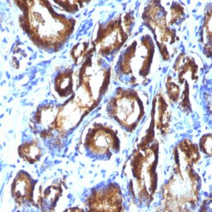 Formalin-fixed, paraffin-embedded human Prostate Carcinoma stained with PSA Monoclonal Antibody (KLK3/801 + KLK3/1248).