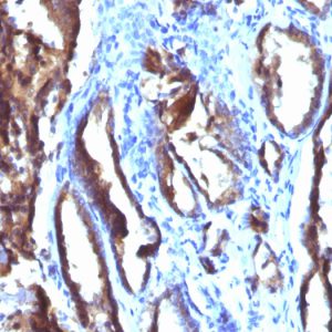 Formalin-fixed, paraffin-embedded human Prostate Carcinoma stained with PSA Monoclonal Antibody (3E6).
