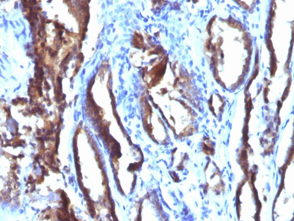 Formalin-fixed, paraffin-embedded human Prostate Carcinoma stained with PSA Monoclonal Antibody (3E6).