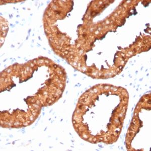 Formalin-fixed, paraffin-embedded human prostate carcinoma stained with PSA Recombinant Rabbit Monoclonal Antibody (KLK3/4551R).