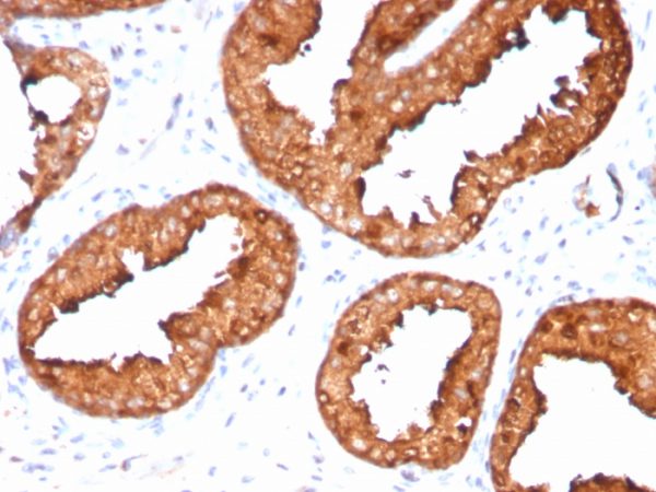 Formalin-fixed, paraffin-embedded human prostate carcinoma stained with PSA Recombinant Rabbit Monoclonal Antibody (KLK3/4551R).