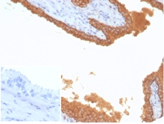 Formalin-fixed, paraffin-embedded human prostate carcinoma stained with PSA Recombinant Rabbit Monoclonal Antibody (KLK3/7128R) at 2ug/ml. Inset: PBS instead of primary antibody; secondary only negative control.