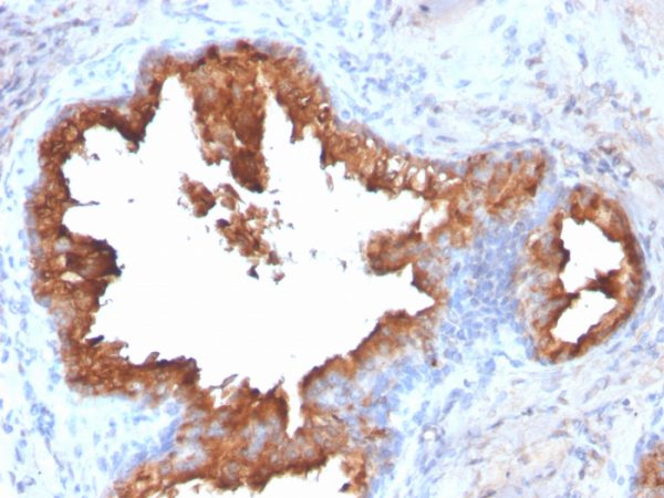 Formalin-fixed, paraffin-embedded human Prostate Carcinoma stained with PSA Rabbit Recombinant Monoclonal Antibody (KLK3/2871R).
