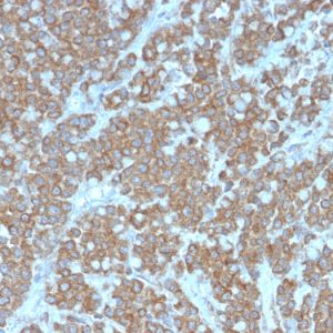Formalin-fixed, paraffin-embedded human colon carcinoma stained with Interleukin-1 alpha (IL-1A) Mouse Monoclonal Antibody (IL1A/3981).