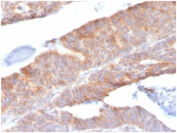 Formalin-fixed, paraffin-embedded human colon stained with Interleukin-1 Beta (IL-1B) Mouse Monoclonal Antibody (IL1B/3993).