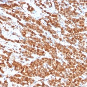 Formalin-fixed, paraffin-embedded human colon carcinoma stained with Interleukin-2 (IL-2) Mouse Monoclonal Antibody (IL2/3949). HIER: Tris/EDTA, pH9.0, 45min. 2°C: HRP-polymer, 30min. DAB, 5min.