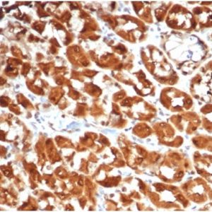 Formalin-fixed, paraffin-embedded human colon carcinoma stained with Interleukin-2 (IL-2) Recombinant Rabbit Monoclonal Antibody (IL2/7051R). HIER: Tris/EDTA, pH9.0, 45min. 2°C: HRP-polymer, 30min. DAB, 5min.
