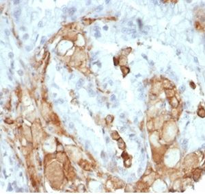 Formalin-fixed, paraffin-embedded human colon carcinoma stained with Interleukin-2 (IL-2) Recombinant Rabbit Monoclonal Antibody (IL2/7050R). HIER: Tris/EDTA, pH9.0, 45min. 2°C: HRP-polymer, 30min. DAB, 5min.