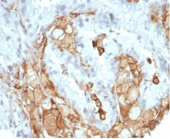 Formalin-fixed, paraffin-embedded human colon carcinoma stained with Interleukin-2 (IL-2) Recombinant Rabbit Monoclonal Antibody (IL2/7050R). HIER: Tris/EDTA, pH9.0, 45min. 2 °: HRP-polymer, 30min. DAB, 5min.