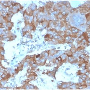 Formalin-fixed, paraffin-embedded human adrenalgland stained with Interleukin-3 (IL-3) Mouse Monoclonal Antibody (IL3/4004). HIER: Tris/EDTA, pH9.0, 45min. 2°C: HRP-polymer, 30min. DAB, 5min.