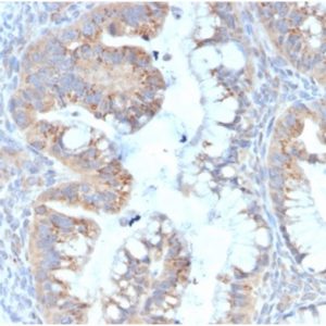 Formalin-fixed, paraffin-embedded human colon carcinomastained with Interleukin-7 (IL-7) Mouse Monoclonal Antibody (IL7/4013). HIER: Tris/EDTA, pH9.0, 45min. 2°C: HRP-polymer, 30min. DAB, 5min.