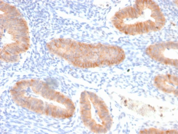 Formalin-fixed, paraffin-embedded human endo-cervical carcinoma stained with Interleukin 10 Recombinant Rabbit Monoclonal Antibody (IL10/2651R).