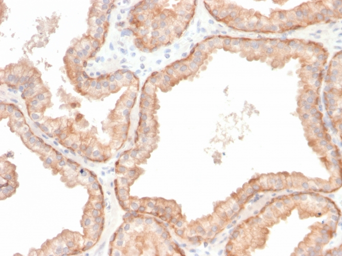 Formalin-fixed, paraffin-embedded human prostate carcinoma stained with Interleukin 10 Recombinant Rabbit Monoclonal Antibody (IL10/2651R). Recombinant Interleukin 10 (IL10) (Immuno-regulation Marker) Antibody - Image 2