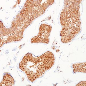 Formalin-fixed, paraffin-embedded human testicular carcinoma stained with Inhibin, alpha Mouse Monoclonal Antibody (INHA/1168).