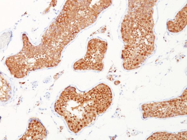 Formalin-fixed, paraffin-embedded human testicular carcinoma stained with Inhibin, alpha Mouse Monoclonal Antibody (INHA/1168).