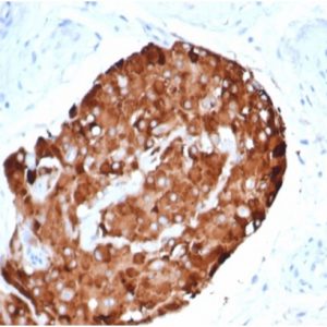 IHC analysis of formalin-fixed, paraffin-embedded humantesticular carcinoma. Staining withrINHA/6919at 2ug/ml in PBS for 30min RT. HIER: Tris/EDTA, pH9.0, 45min. 2 °: HRP-polymer, 30min. DAB, 5min.