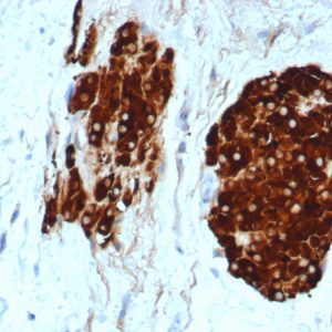 IHC analysis of formalin-fixed, paraffin-embedded human testicular carcinoma. Staining with INHA/6598R at 2ug/ml in PBS for 30min RT. HIER: Tris/EDTA, pH9.0, 45min. 2 °: HRP-polymer, 30min. DAB, 5min.