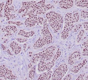 Formalin-fixed, paraffin-embedded human neuroendocrine tumor stained with INSM-1 Recombinant Rabbit Monoclonal Antibody (INSM1/6286R).