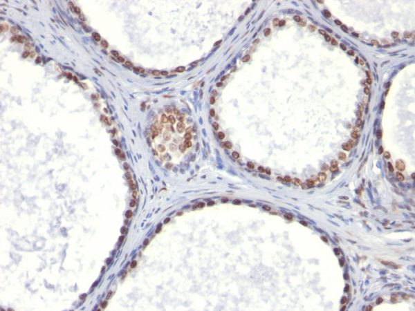 Formalin-fixed, paraffin-embedded human Prostate Carcinoma stained with Androgen Receptor Mouse Monoclonal Antibody (AR441).