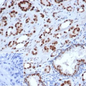 Formalin-fixed, paraffin-embedded human prostate carcinoma stained with Androgen Receptor Recombinant Mouse Monoclonal Antibody (rDHTR/6818). Inset: PBS instead of primary, secondary antibody control.